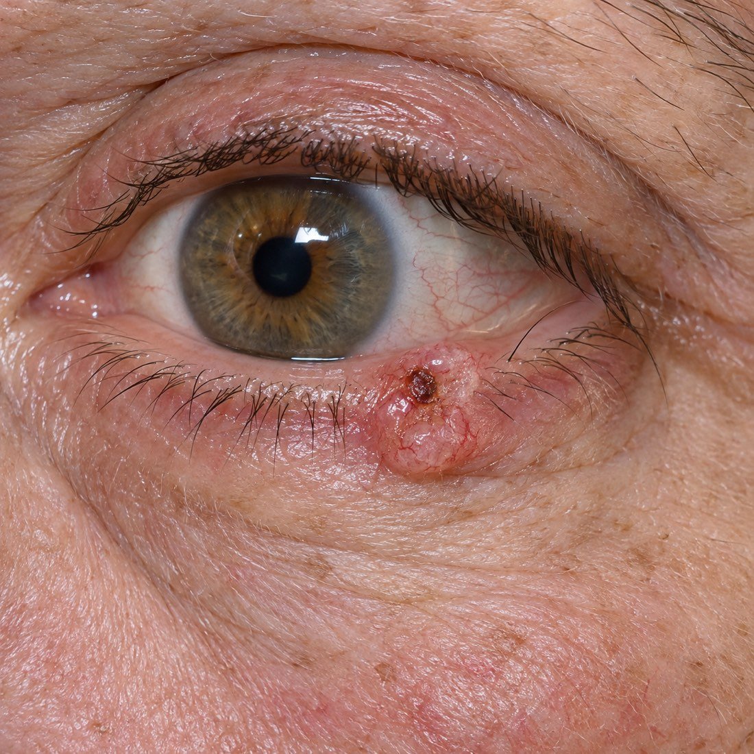 Close-up of a lower eyelid with a basal cell carcinoma: a firm pearly lump with rolled edges, a crusted ulcer at its center and eyelashes missing over it