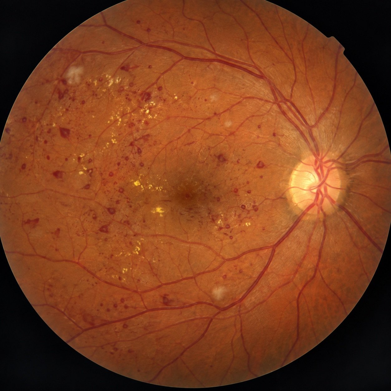 Retinal photograph showing diabetic retinopathy: scattered dot hemorrhages, yellow hard exudates and white cotton wool spots across the retina